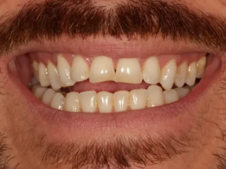 Antes - caso 2